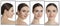 Photos of woman with lifting marks on face against white background, collage. Cosmetic surgery