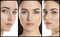 Photos of young woman with lifting marks on face against background, collage. Cosmetic surgery