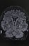 Phottography of human brain MRI in coronal view