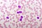 Picture of acute lymphocytic leukemia or ALL cells