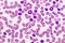 Picture of acute lymphocytic leukemia or ALL cells in blood smear
