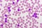 Picture of acute lymphocytic leukemia or ALL cells in blood smear