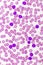 Picture of acute lymphocytic leukemia or ALL cells in blood smear