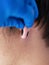 Piercing and stretching the ears with medical  blue gloves. increase the diameter of the ear tunnels