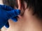 Piercing and stretching the ears with medical  blue gloves. increase the diameter of the ear tunnels