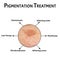 Pigmentation on the skin. Brown spots on the skin. Pigmentation treatment. Infographics. Vector illustration on isolated