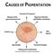 Pigmentation on the skin causes. Brown spots on the skin. Pigmentation treatment. Infographics. Vector illustration on