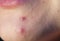 Pimple on the chin