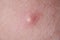 Pimple with purulent discharge on skin closeup
