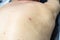 A pimple on the skin of a light-skinned man