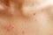 pimples skin. female body skin in pimples