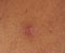 Pink pimple on human skin