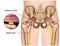 Piriformis syndrome 3d medical  illustration on white background