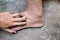 Pitting edema of lower limb. Swollen leg of Asian man