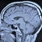 Pituitary adenoma brain image mri