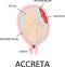 Placenta accreta. grades of abnormal attachment illustrated according to the depth