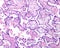 Placenta. Erythroblastosis fetal