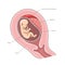 Placental abruption structure medical science