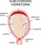 Placental hematoma. blood clots that arise from the placenta