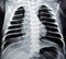 plain chest x ray for a newborn infant in incubator with a right lung congenital pneumonia at the right apex