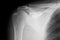 Plain film X-ray of shoulder - radiography, normal