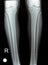 Plain X ray of both right and left knee joints with lower part of femur and upper parts of tibia and fibula and patella showing