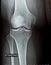 plain x ray on knee joint showing joint space narrowing and Subchondral Sclerosis on medial compartment