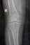 Plain X ray of the right knee shows apparent joint osteoarthritis according to Kellgren and Lawrence system