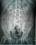 Plain X-Ray of urinary tract kidney, ureter and urinary bladder anteroposterior view