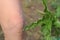 Plant stinging nettle next to irritated human knee skin covered with small wrinkles,cracks and causes burn with blisters