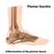 Plantar fasciitis