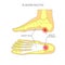 Plantar fasciitis