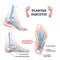 Plantar fasciitis as fascia muscle inflammation and tearing outline diagram