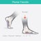 Plantar Fasciitis. Illustration human foot.