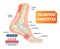 Plantar fasciitis vector illustration. Labeled human feet disorder diagram.