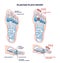 Plantar plate injury anatomy and foot capsule torn trauma outline diagram.