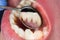 Plaque of the patient, stone. Dentistry treatment of dental plaque, professional oral hygiene. The concept of harm to smoking and