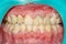 Plaque of the patient, stone. Dentistry treatment of dental plaque, professional oral hygiene. The concept of harm to smoking and