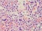 Plasmablastic anaplastic Multiple Myeloma - Close up of Plasma Cells