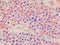 Plasmablastic anaplastic Multiple Myeloma - Plasmacytoma Biopsy Specimen