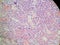 Plasmablastic anaplastic Multiple Myeloma - Plasmacytoma Biopsy Specimen