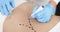 Plastic surgeon drawing preoperative markings on patient abdomen closeup 4k movie slow motion