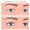 Plastic surgery_Blepharoplasty eyelid surgery