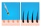 Platelet-Rich plasma . prp . hair growth vector