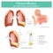 Pleural effusion the high-protein pleural effusion.