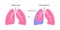 Pleural effusion poster