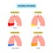 Pleural effusion poster