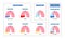 Pleural effusion poster