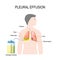 Pleural effusion. Treatment of tension hydrothorax