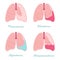 Pleural effusions of human lung. Fluid or air in pleural cavity - vector anatomical scheme. Comparison some types